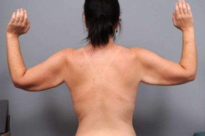 Arm Lift Before & After Patient #819