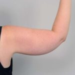 Arm Liposuction Before & After Patient #826