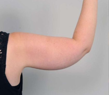 Arm Liposuction Before & After Patient #826