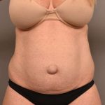 Tummy Tuck Before & After Patient #273