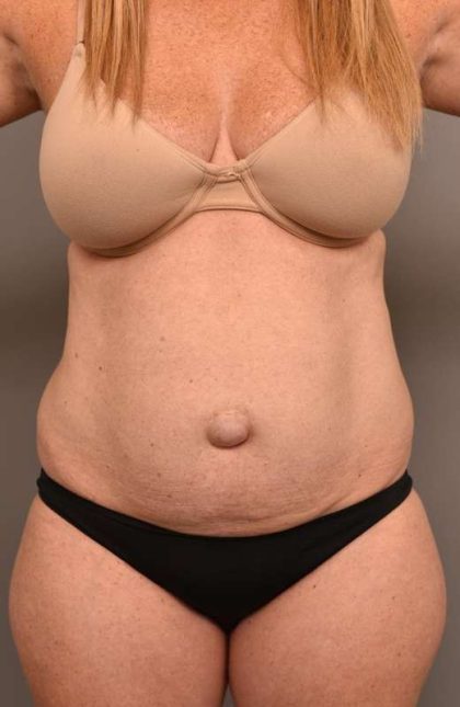 Tummy Tuck Before & After Patient #273