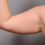 Arm Liposuction Before & After Patient #842