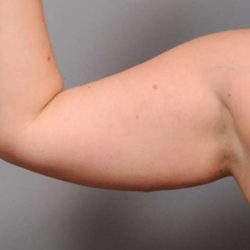 Arm Liposuction Before & After Patient #842