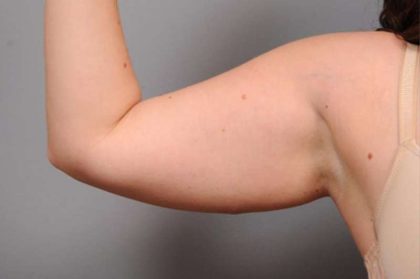 Arm Liposuction Before & After Patient #842