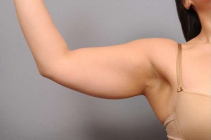 Arm Liposuction Before & After Patient #851