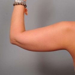 Arm Liposuction Before & After Patient #858