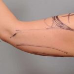 Arm Liposuction Before & After Patient #863