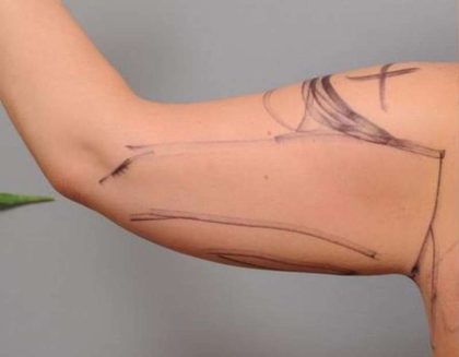Arm Liposuction Before & After Patient #863