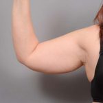 Arm Liposuction Before & After Patient #872