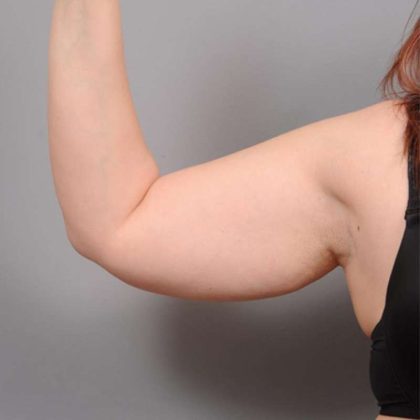 Arm Liposuction Before & After Patient #872