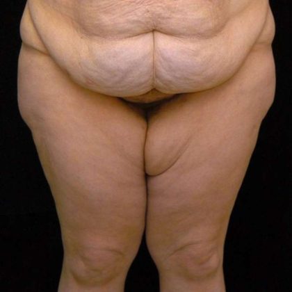 Thigh Lift Before & After Patient #882