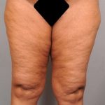 Thigh Lift Before & After Patient #885