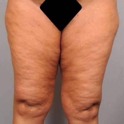 Thigh Lift Before & After Patient #885