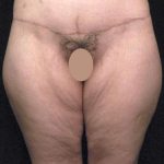 Thigh Lift Before & After Patient #888