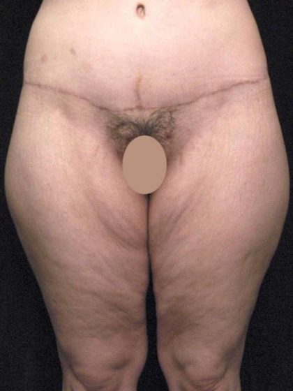 Thigh Lift Before & After Patient #888
