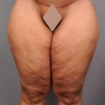 Thigh Lift Before & After Patient #891