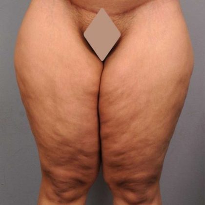 Thigh Lift Before & After Patient #891