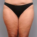 Thigh Lift Before & After Patient #896