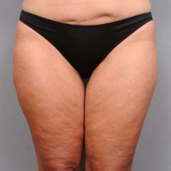 Thigh Lift Before & After Patient #896
