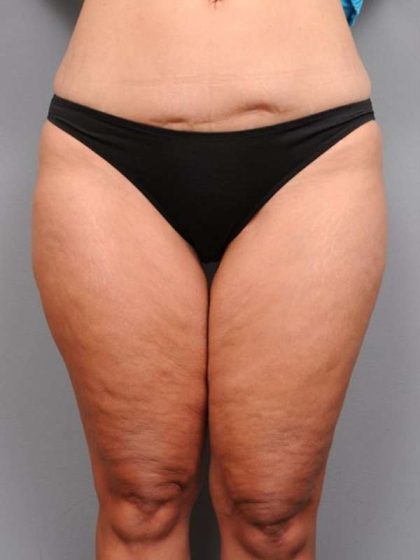 Thigh Lift Before & After Patient #896
