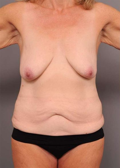 Upper Body Lift Before & After Patient #905