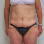 Lower Body Lift Before & After Patient #925