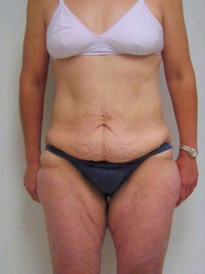 Lower Body Lift Before & After Patient #925