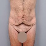 Lower Body Lift Before & After Patient #932