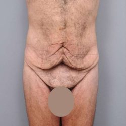 Lower Body Lift Before & After Patient #932
