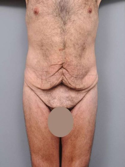 Lower Body Lift Before & After Patient #932