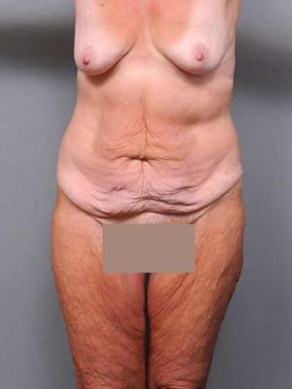 Lower Body Lift Before & After Patient #965