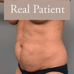 Tummy Tuck Before & After Patient #303