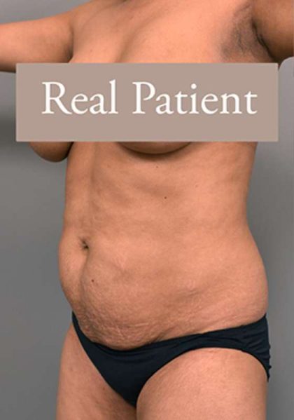 Tummy Tuck Before & After Patient #303