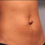 Belly Button Surgery Before & After Patient #1079