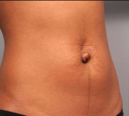 Belly Button Surgery Before & After Patient #1079