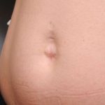 Belly Button Surgery Before & After Patient #1084