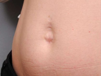 Belly Button Surgery Before & After Patient #1084