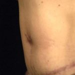 Belly Button Surgery Before & After Patient #1089