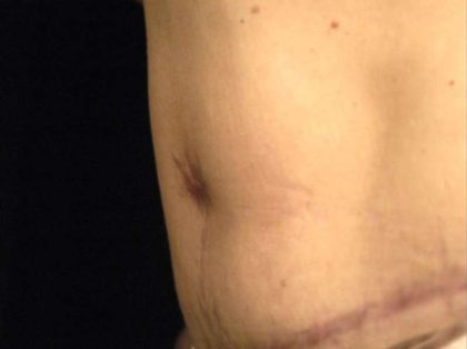 Belly Button Surgery Before & After Patient #1089