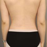 Scarless Rib Contouring (RibXcar) Before & After Patient #1097