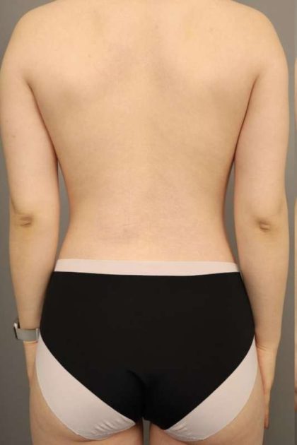 Scarless Rib Contouring (RibXcar) Before & After Patient #1097