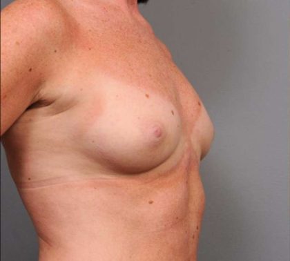 Under The Muscle Breast Augmentation Before & After Patient #1128