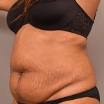 Tummy Tuck Before & After Patient #312