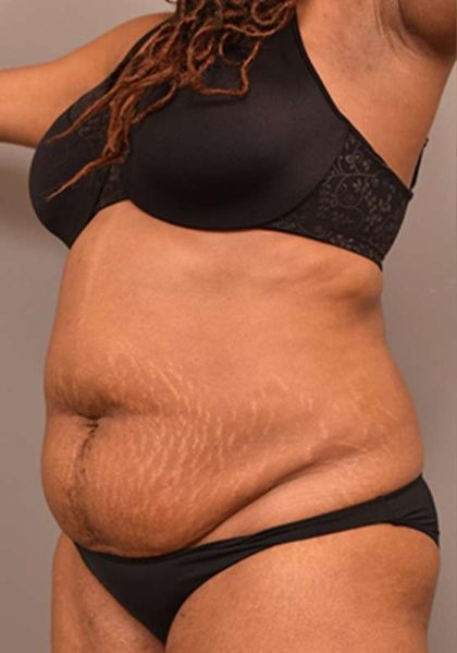 Tummy Tuck Before & After Patient #312