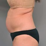 Tummy Tuck Before & After Patient #319