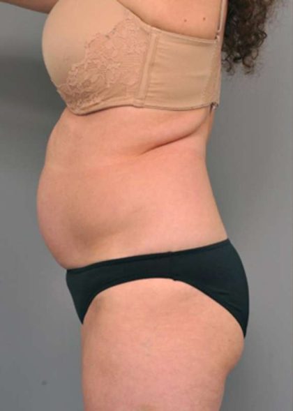 Tummy Tuck Before & After Patient #319