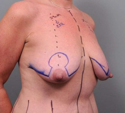 Breast Lift Before & After Patient #1221