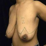 Breast Lift Before & After Patient #1262