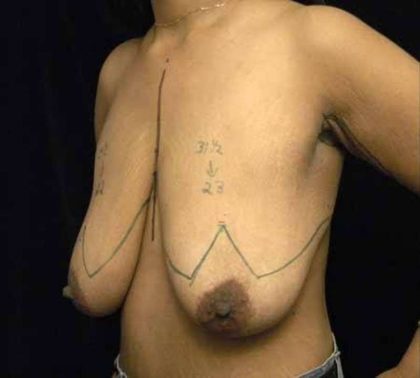 Breast Lift Before & After Patient #1262