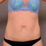 Tummy Tuck Before & After Patient #329